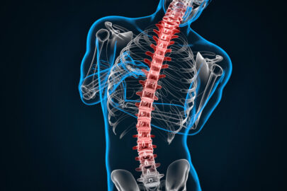 Spondylosis and Scoliosis - slon.pics - free stock photos and illustrations