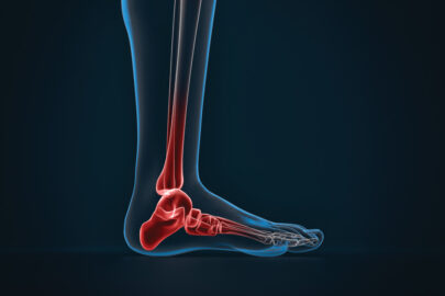 Arthritis of ankle. X-ray of foot. Lateral view - slon.pics - free stock photos and illustrations